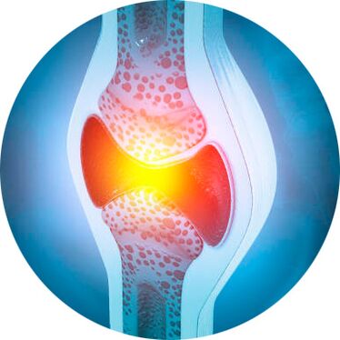 Proceso de restauración de articulaciones con gel Icexin.