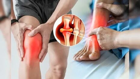 Zonas de la piel aptas para la aplicación del gel Icexin (rodillas, codos, zona lumbar)