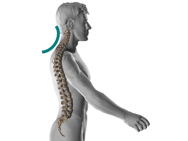 Osteocondrosis cervical de la columna, que causa muchos síntomas desagradables.