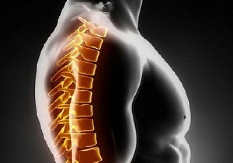La osteocondrosis torácica acompaña al dolor y al malestar en la parte media de la espalda.