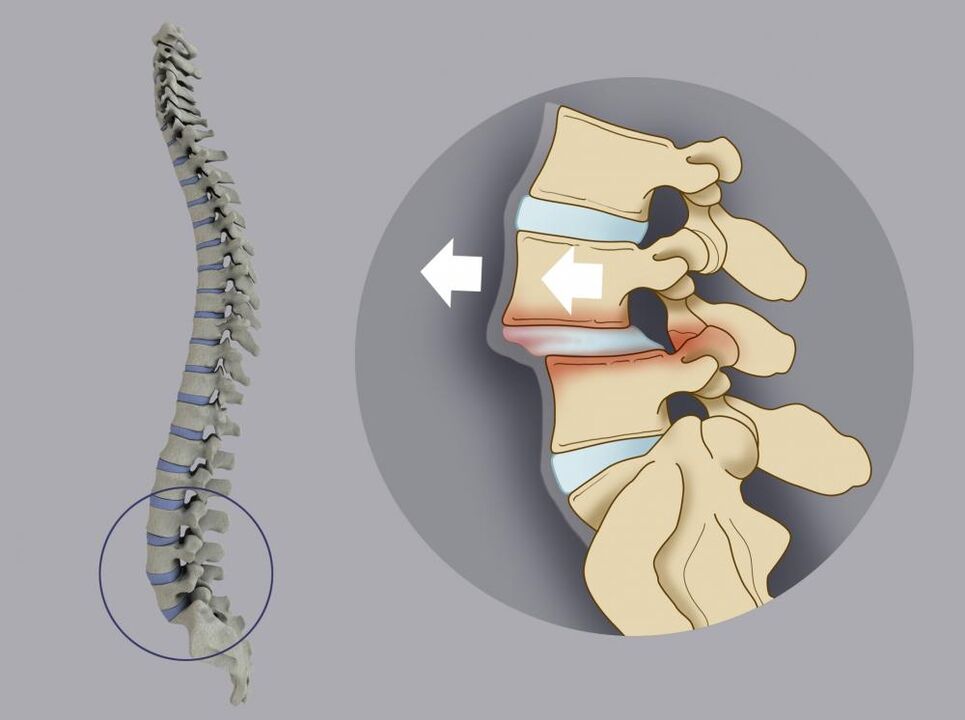 Desalineación vertebral como causa de dolor lumbar.