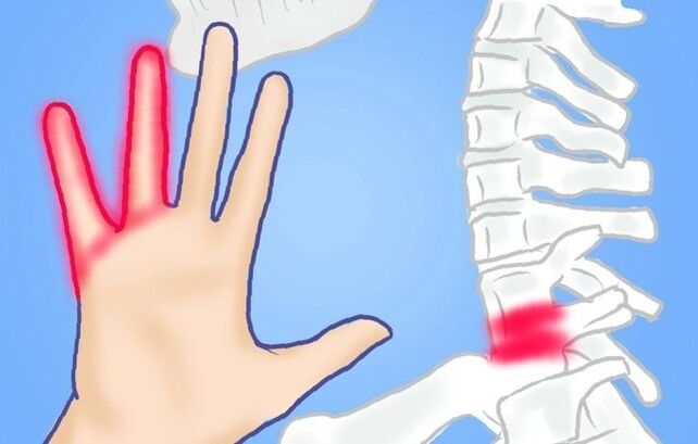 Nervios pellizcados como causa de dolor lumbar.