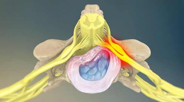 síndrome radicular como causa de dolor lumbar