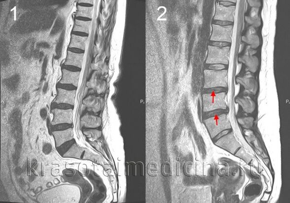 osteocondrosis espinal